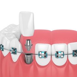 A digital image of a set of metal braces and a dental implant replacing a missing tooth