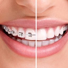 Close-up image of a smile before and after braces