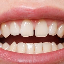 An individual smiling to expose a gap between their upper front two teeth