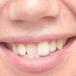A person smiling and showing off their crooked teeth