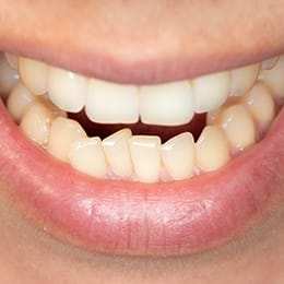 A person smiling to expose their bottom arch of teeth, which are overcrowded