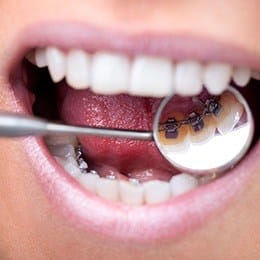 Closeup of smile with lingual braces