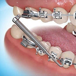 Animation of Forsus appliance treatment