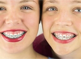 teens with braces