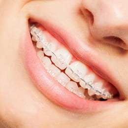 A mouth with clear braces