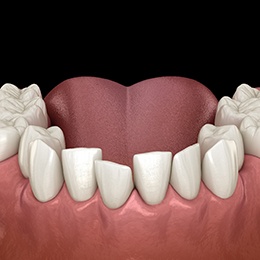 Illustration of crooked teeth