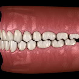 Illustration of underbite