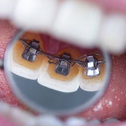 an example of lingual braces behind a patient’s teeth