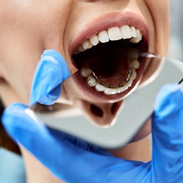 a dentist holding a mirror to show a patient’s lingual braces