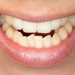 A person’s mouth open and exposing their crowded teeth along the lower arch