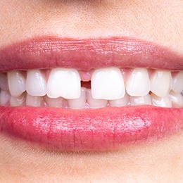 A person’s mouth that is open and exposing their teeth, which have a large gap between the upper front two teeth