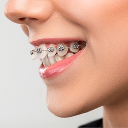 A person smiling and showing off their metal braces and overbite