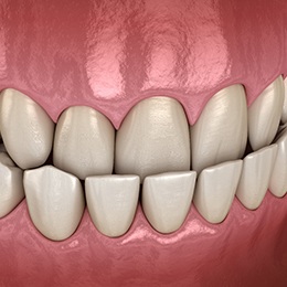 A digital image of what an underbite looks like with the top teeth sitting behind the lower teeth when the mouth is closed