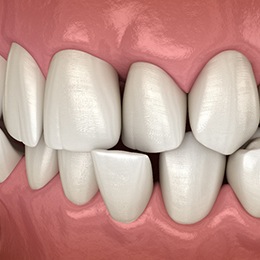 Digital image of what a crossbite looks like with the teeth overlapping each other