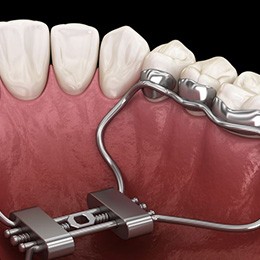 Illustration of a palatal expander