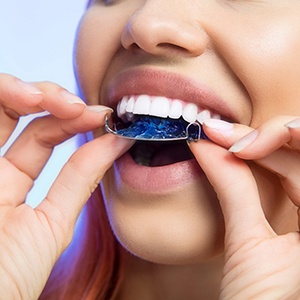 A woman putting a removable retainer in her mouth