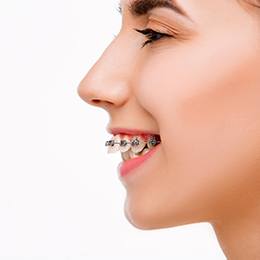 A young female wearing traditional braces to fix an overbite