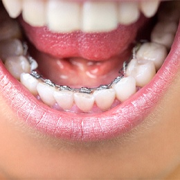 An up-close image of a person’s mouth and the lower teeth that appear crowded and lingual braces placed on the backside of each tooth