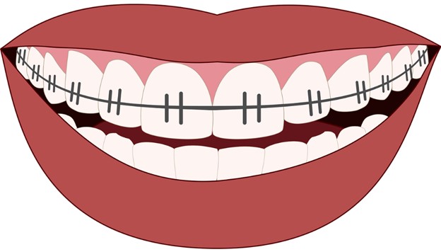 Drawing of smile with braces.