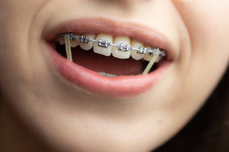 a patient with rubber bands on braces in Huntington