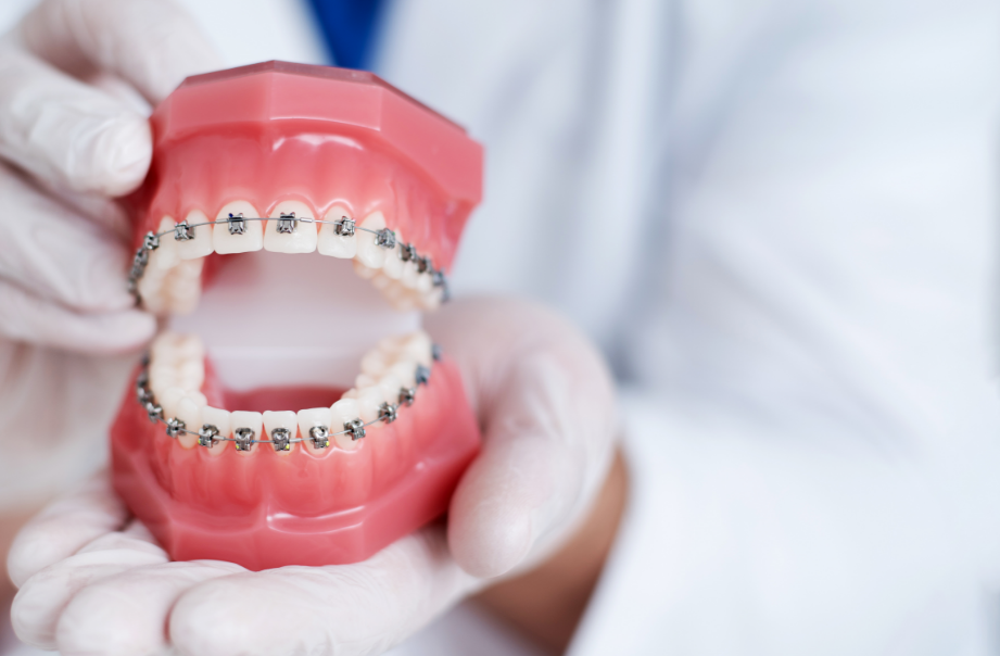 Image of dental mold with braces