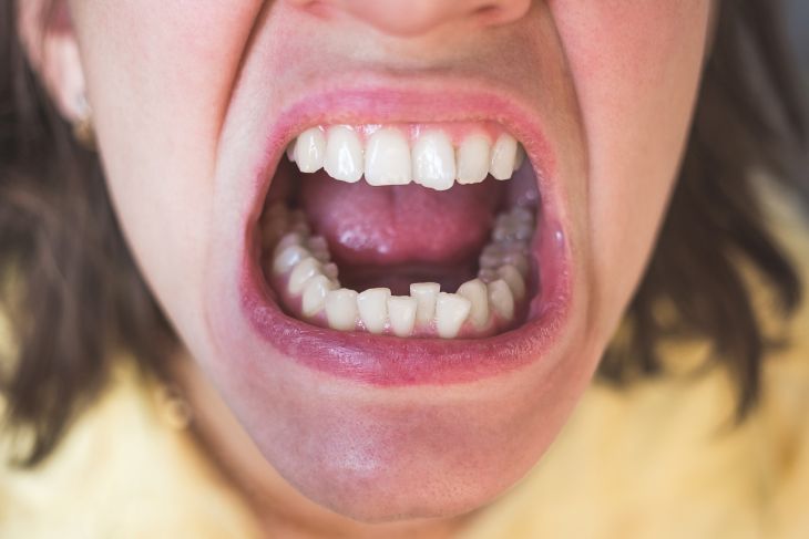 A man with crooked teeth